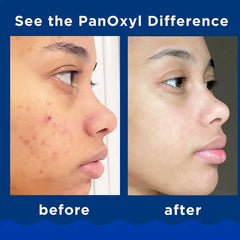 PanOxyl Acne Foaming Wash 10% Benzoyl Peroxide Maximum Strength 156 g